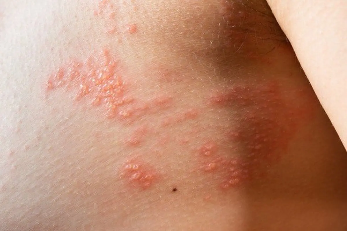 این علائم جسمی و روحی یعنی زونا گرفته اید