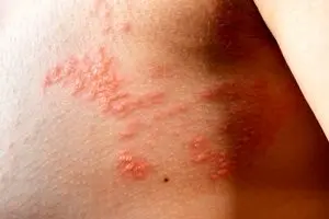 این علائم جسمی و روحی یعنی زونا گرفته اید