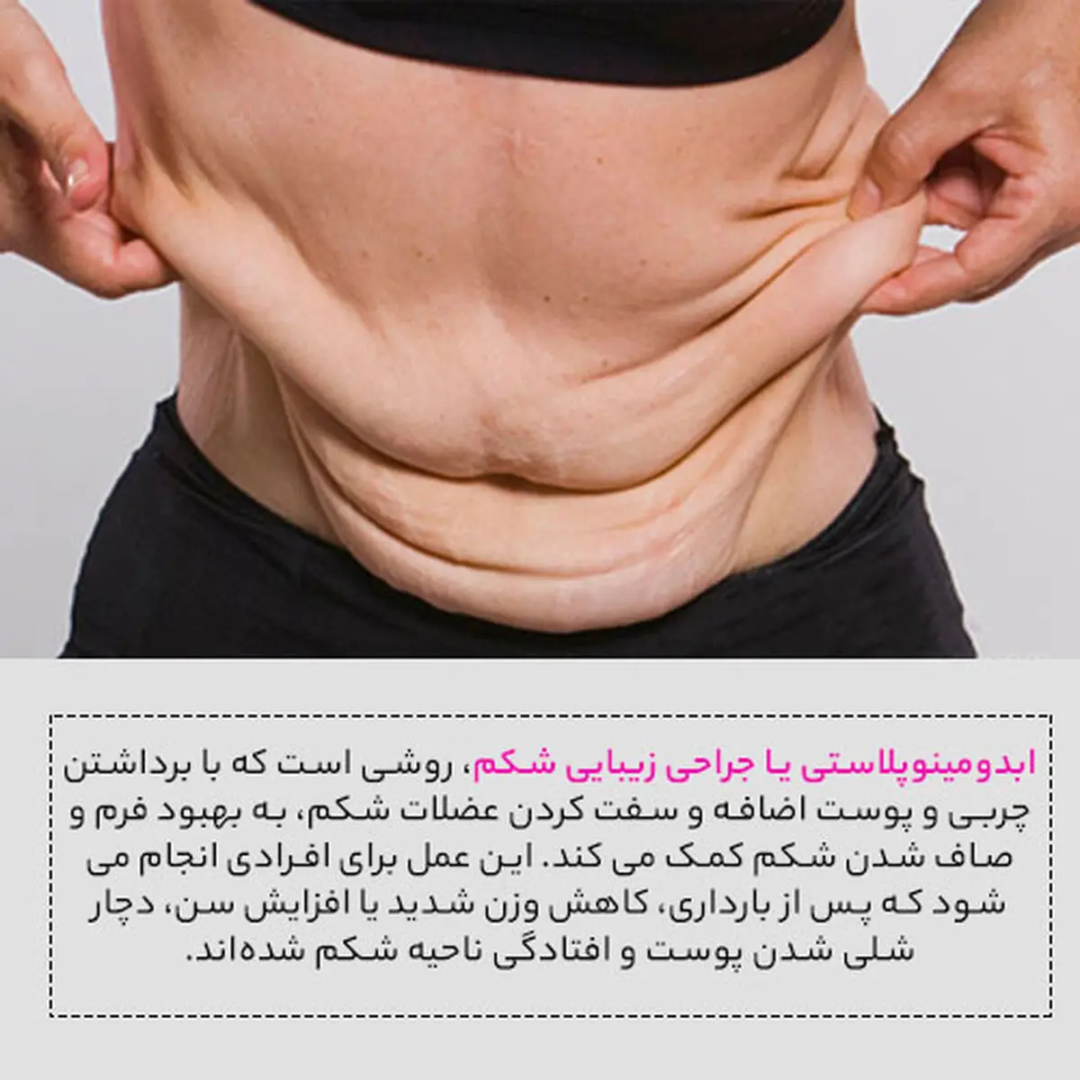 ابدومینوپلاستی برای چه افرادی مناسب است؟