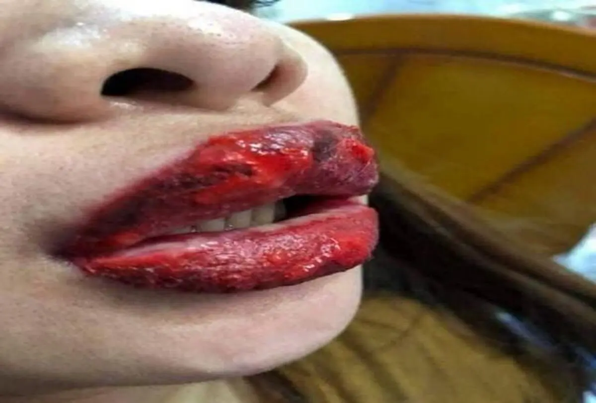 بلای فجیعی که رژلب تقلبی به سر لب‌های  زن جوان آورد