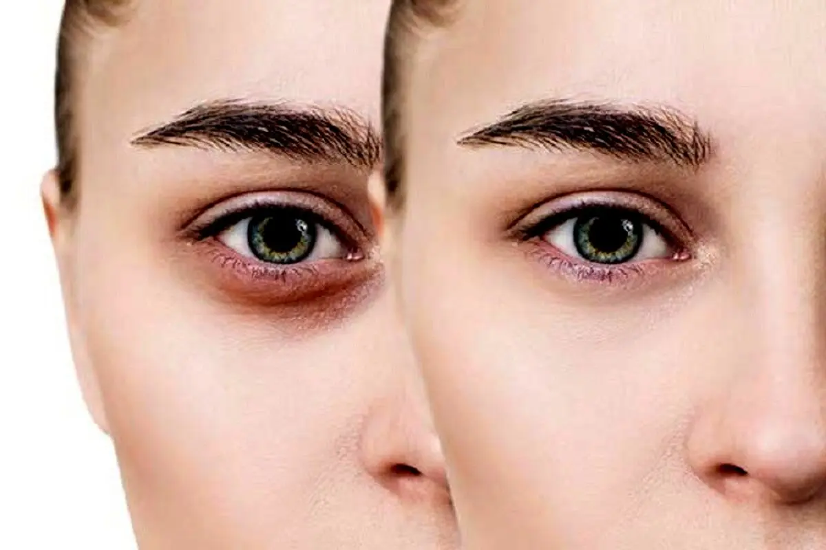 کربوکسی تراپی صورت بدون تزریق ممکن است؟