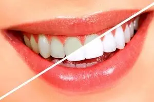 بعد از صرف صبحانه مسواک نزنید