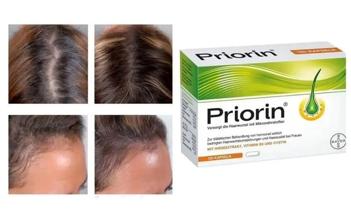 بهترین مکمل های ضدریزش و تقویت مو در سال 2025
