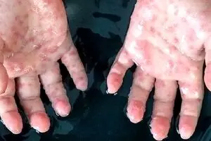 شناسایی ۹ مورد مشکوک به آبله میمونی در ایران
