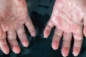 شناسایی ۹ مورد مشکوک به آبله میمونی در ایران