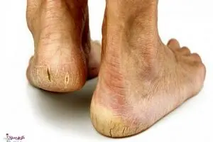 درمان خشکی و ترک پا با این مواد خونگی | با این ترکیب کف پاهاتو مثل آینه کن