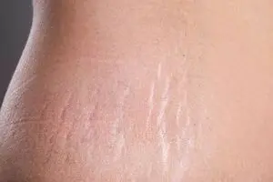 بهترین روش برای از بین بردن سلولیت و ترک های بدن