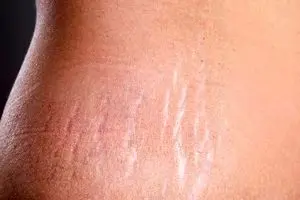 بهترین روش برای از بین بردن سلولیت و ترک های بدن