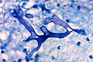 توضیح وزارت بهداشت راجب به قارچ سیاه