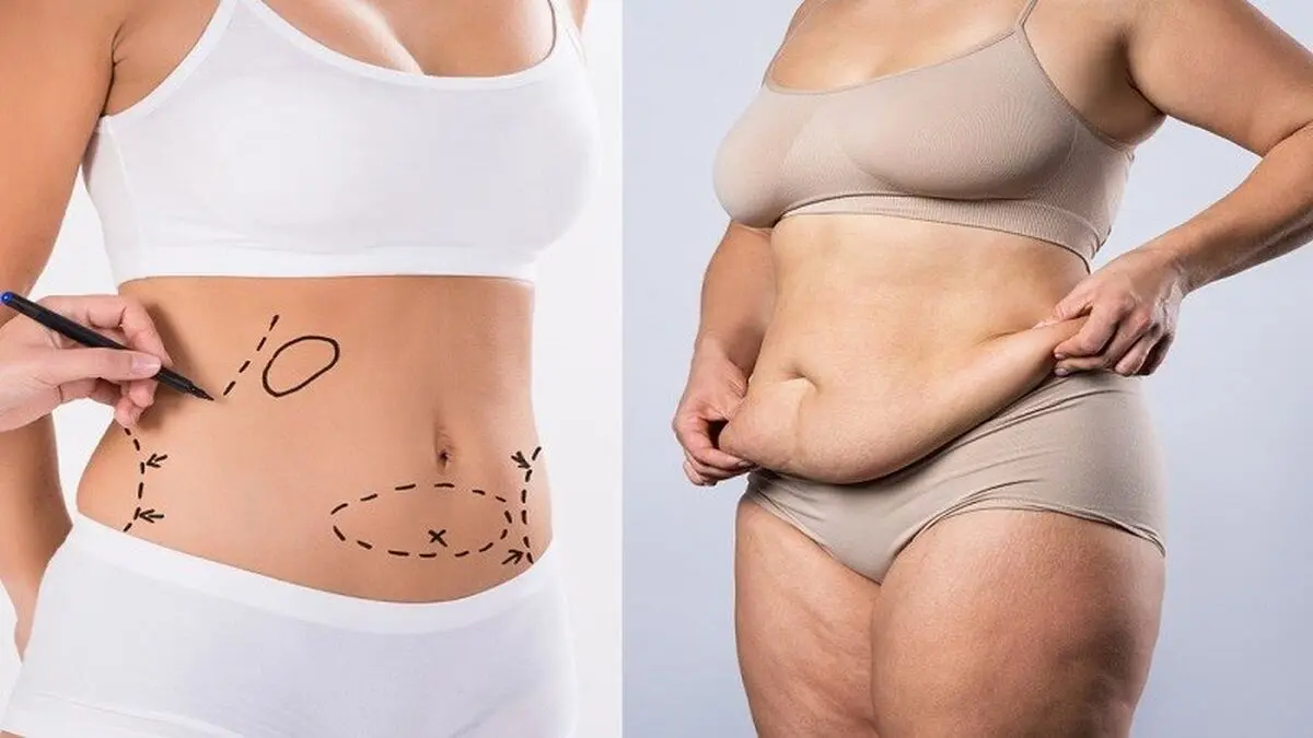 همه چیز درباره لیپوماتیک فول بادی