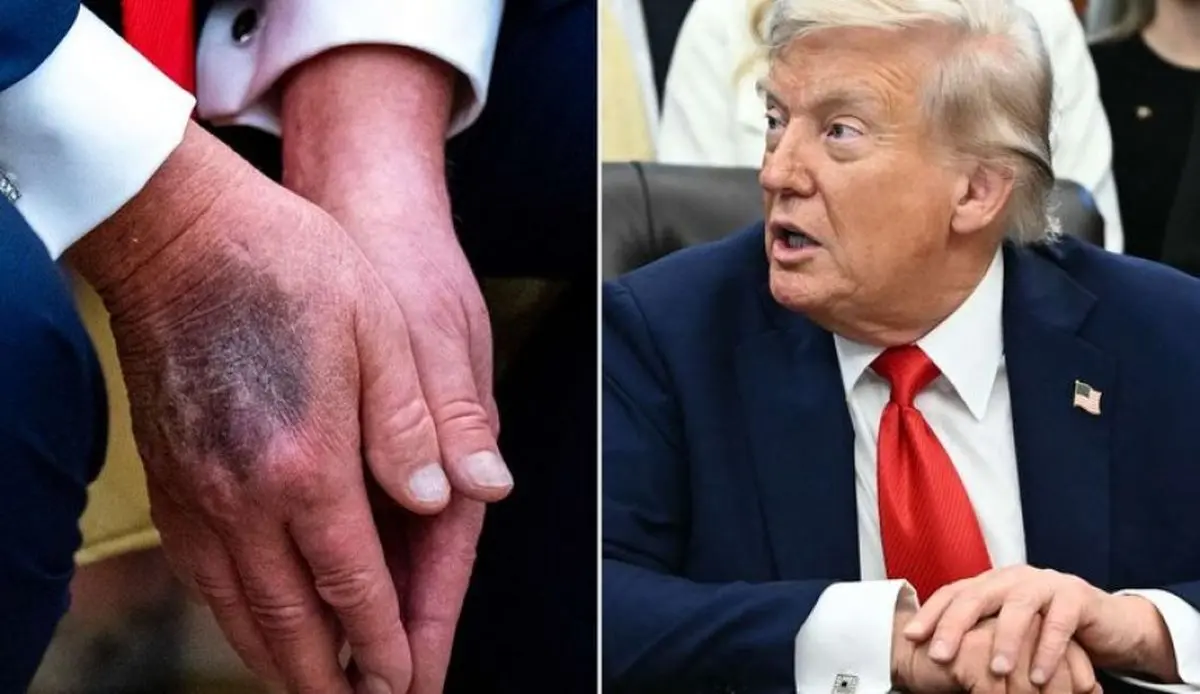 پیش بینی پزشک فیزیوتراپیست از زمان مرگ ترامپ! | بیماری ترامپ وخیم شد؟