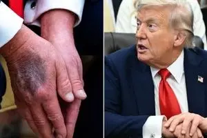 پیش بینی پزشک فیزیوتراپیست از زمان مرگ ترامپ! | بیماری ترامپ وخیم شد؟