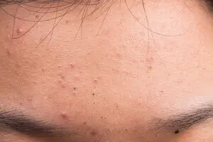 راه های معجزه آسا برای از بین بردن جوش سر سیاه
