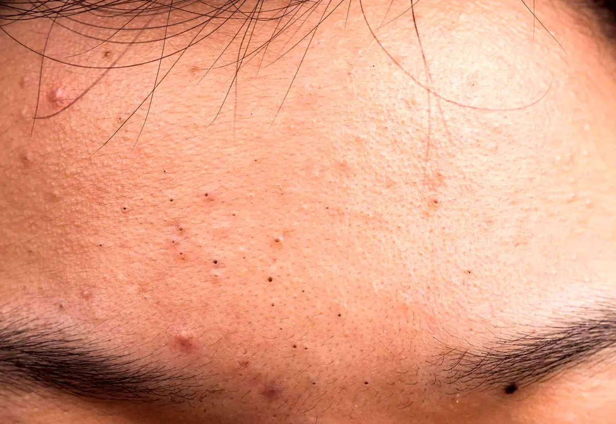 راه های معجزه آسا برای از بین بردن جوش سر سیاه