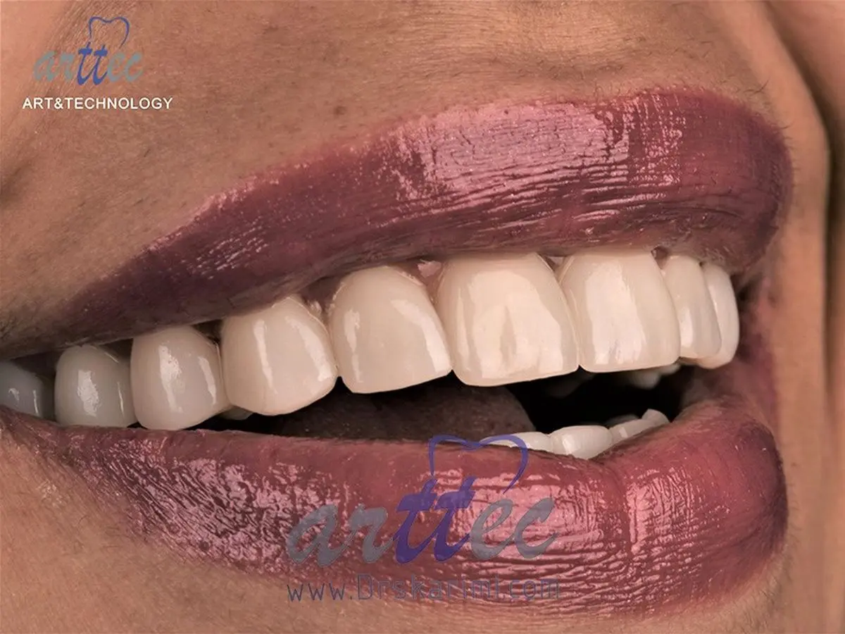 دندان های سفید چه تاثیری بر زندگی دارد؟