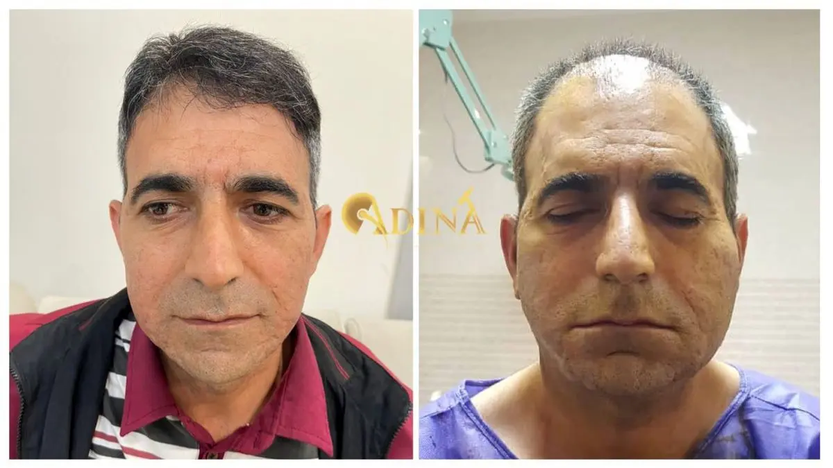 آیا روش های کاشت مو در ایران دائمی است؟