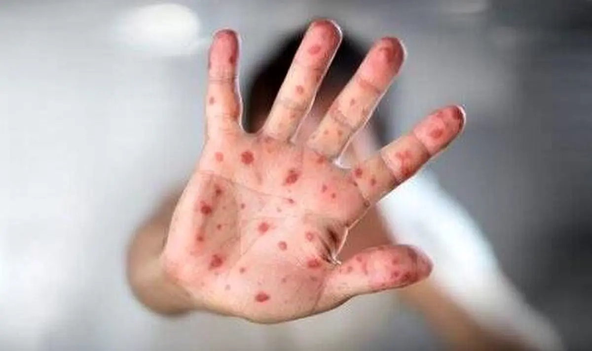 کمین یک بیماری مرگبار دیگر پشت مرزهای ایران | بیماری سرخک مرگبار در کمین ایران