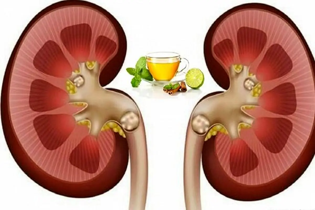 افراد مبتلا به سنگ گلیه چند توصیه ارزان برای رهایی شما از شر سنگ ها
