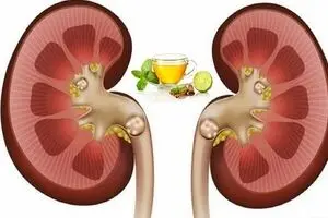 افراد مبتلا به سنگ گلیه چند توصیه ارزان برای رهایی شما از شر سنگ ها