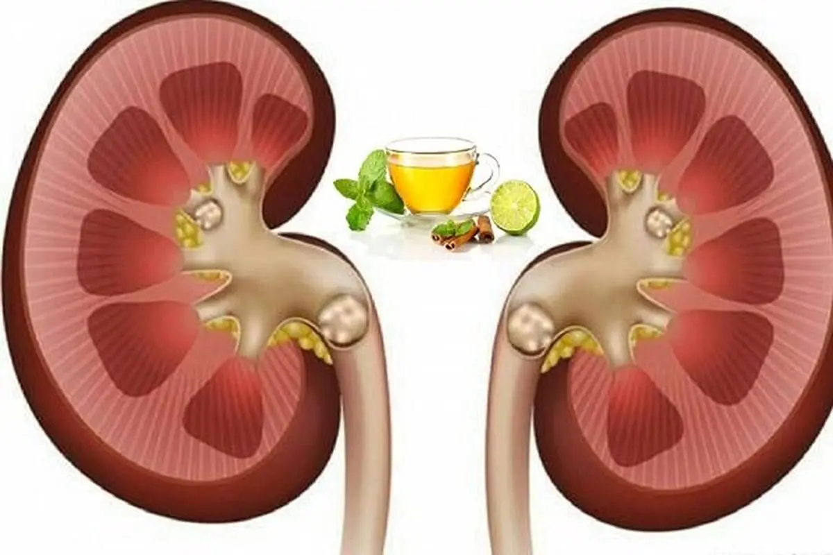 افراد مبتلا به سنگ گلیه چند توصیه ارزان برای رهایی شما از شر سنگ ها