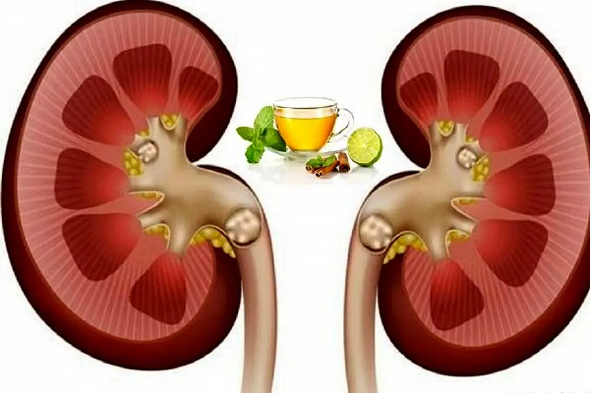 افراد مبتلا به سنگ گلیه چند توصیه ارزان برای رهایی شما از شر سنگ ها