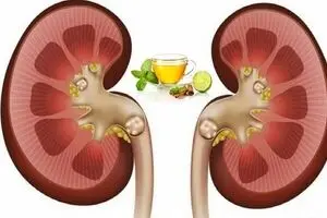 افراد مبتلا به سنگ گلیه چند توصیه ارزان برای رهایی شما از شر سنگ ها
