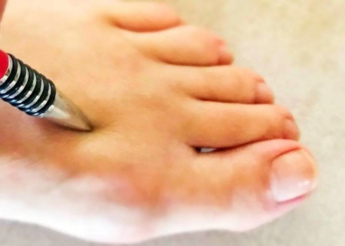 کاهش فشار خون با طب فشار نقطه ای فقط با یک خودکار