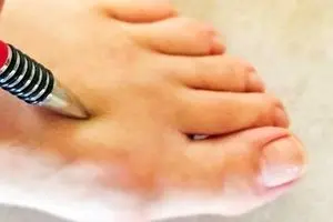 کاهش فشار خون با طب فشار نقطه ای فقط با یک خودکار